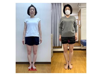 キュア整骨院(CURE整骨院)/Ｏ脚矯正コース実績５