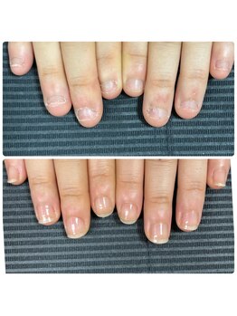 ウェルズユキ(well's yuki)/噛む爪/むしり爪/小さい爪