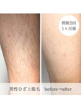 ココスターリー 筑紫野店(Coco starry)/全身脱毛をされる男性が急増中！