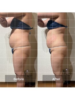 リノリー 仙台荒井店(rinory)/脂肪冷却痩身