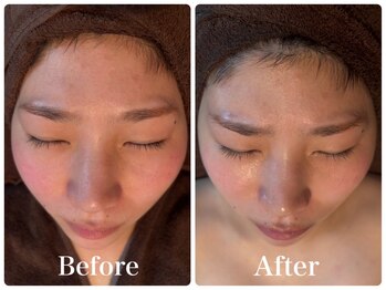 ボヌールデソワ(Bonheur de Soi)/ハーブピーリング/美白/北堀江