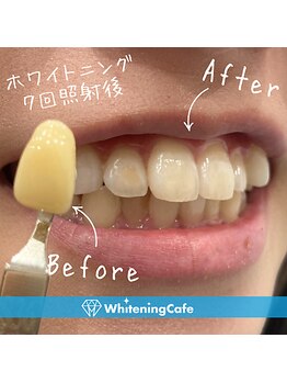 ホワイトニングカフェ 池袋東口店/ホワイトニングビフォーアフター