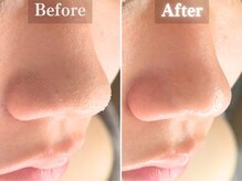 ボーンオム(Born Homme)/毛穴洗浄＋美容液導入：30代女性