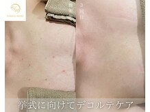 肌耕/デコルテのハーブピーリング