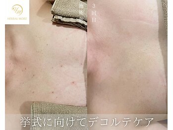 肌耕/デコルテのハーブピーリング