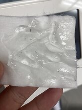 ブリリアント(Brilliant)/メンズ ヒゲ脱毛 実績4