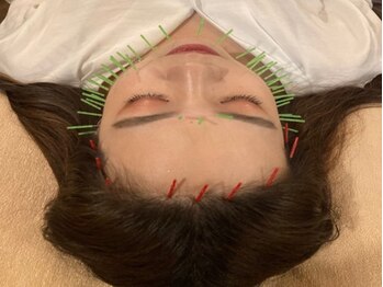 アキュティ 吉祥寺(Acuty)/小顔美容鍼