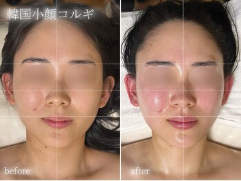 ラ ドゥーサ(La Dusa)/当サロン大人気☆韓国小顔コルギ