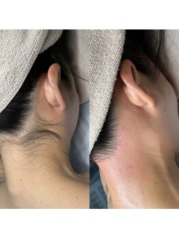 エステリア 蒲田/うなじのダブル脱毛