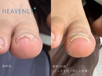 ヘブンリープラス＋ Luz湘南辻堂店/巻き爪補正 矯正 フットケア
