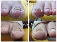 爪切り屋 足楽/【巻き爪】半年～１年ゆっくりと