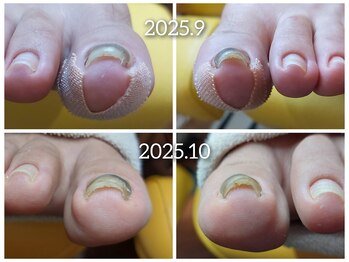 【巻き爪】半年～１年ゆっくりと