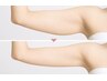 【大人の二の腕悩み】二の腕引き締めコース16.500円→8.250円