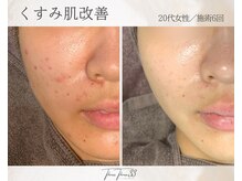 スリースリー 恵比寿(THREE THREE)/くすみ肌・透明感UP ケア