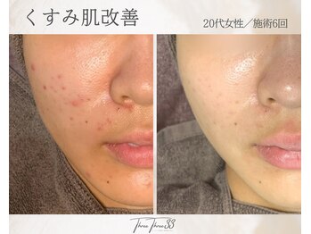 スリースリー 恵比寿(THREE THREE)/くすみ肌・透明感UP ケア