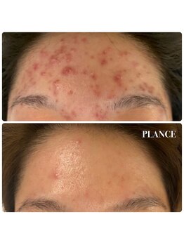 プランス 渋谷(PLANCE)/長年の肌荒れも解決