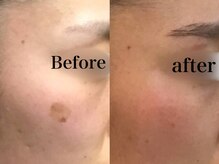 ヒール(heal)/症例