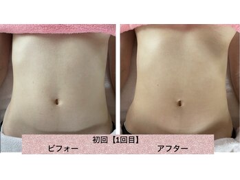 ラレコルト/ビフォーアフター