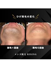 ライジング 熊本菊陽光の森店(RISING)/髭脱毛5回の変化