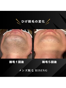 ライジング 熊本菊陽光の森店(RISING)/髭脱毛5回の変化
