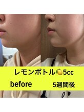 ララチッタ(L'la citta)/レモンボトル5cc