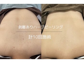 ライフサロン 恵比寿(Life Salon)/背中の肌質改善