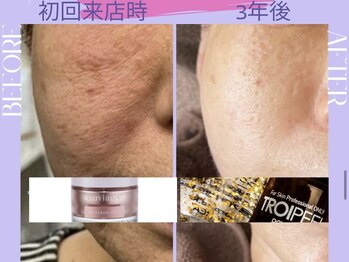 リラクゼーションサロン ラキ(laki)/トロイピール/ハーブピーリング