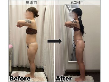 ベルミーランド MEGAドン・キホーテ草加/痩身Before→After