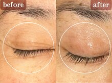 目元のシワ/ほうれい線/たるみを改善/エイジングケア/宮崎市