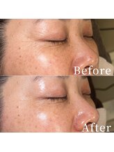 ユカリス(Yu.charis)/水光導入ミコステラBefore/After