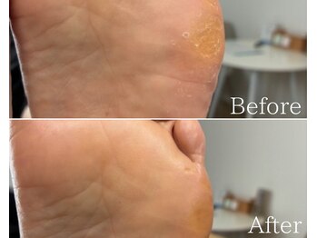 カシェット 広島店(Cachette)/50代女性☆足裏角質ケア90分