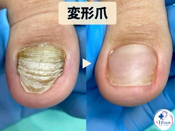 プラスワンフット 本厚木(+1 Foot)/変形爪・肥厚爪1年半の経過
