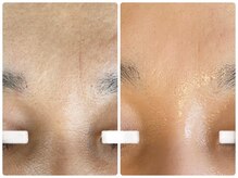 ルミエール シーサイド(L’MIERE seaside)/しわ改善.弾力UP