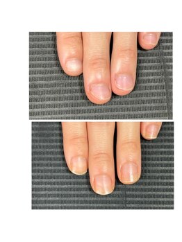 ウェルズユキ(well's yuki)/深爪/短い爪/爪の形/噛み爪