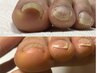 先着5名様【巻き爪ケア】両足親指　15000円→12500円　残2名様