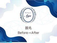 トータルビューティケア アヤ(Aya)/Before/After