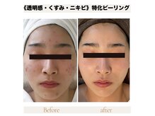 乳酸ピーリング＆ホームケア☆黒ずみ改善、リフトＵＰ効果大！