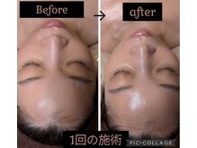 ルアーナ(Luana)/次世代ピーリングダクトピール