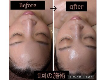 ルアーナ(Luana)/次世代ピーリングダクトピール