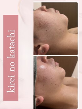 キレイノカタチ(Kirei No Katachi)の写真/新年度に向けて小顔美肌準備♪渡韓いらず《レモンボトル/レッドショット》で脂肪分解しスッキリ小顔実現◎