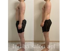 アピ(api)/症例写真【インディバ】