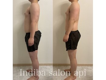 アピ(api)/症例写真【インディバ】