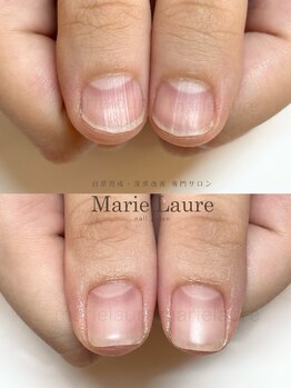 マリーロール 梅田店(Marie Laure)/深爪矯正/自爪育成/自爪風