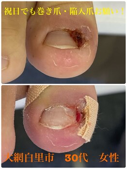 巻き爪じゅん 千葉駅前店/祝日でも巻き爪・陥入爪お願い！