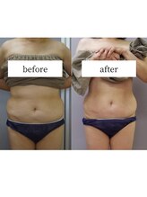 アップルミント/＜痩身＞before・after