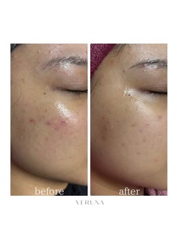 ココ 2号店(CoCo)/肌質改善/ニキビケア