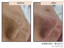 コンビンス(convince)/毛穴ケア