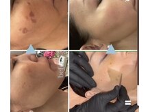 ホワイトラボ　シミケア