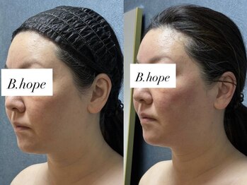 ビーホープ(B.hope)/40代モニター様の変化