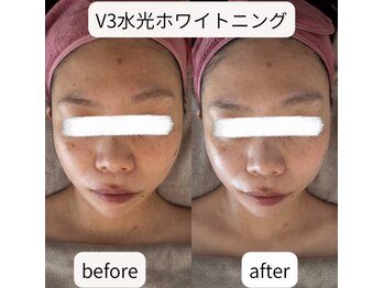 エム シャルール(M chaleur)の写真/1回目でも実感!毛穴・ホワイトニング・シミ・たるみケアで理想の水光ツヤ肌へ